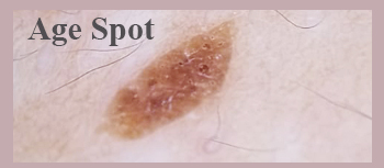 agespot removal hong kong