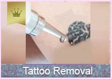 tattoo removal