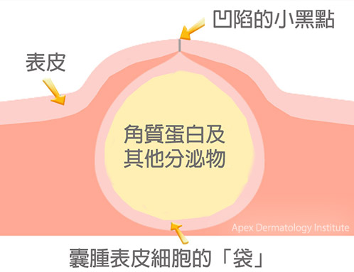 粉瘤