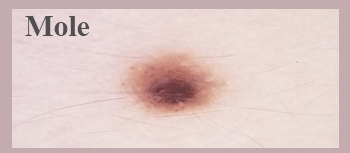 mole removal dermatologist hong kong