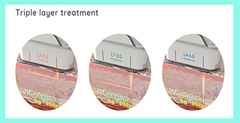 HIFU lifting treatment Hong Kong