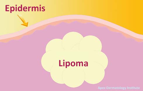 lipoma surgery