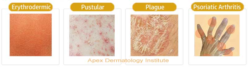 psoriasis doctor hong kong